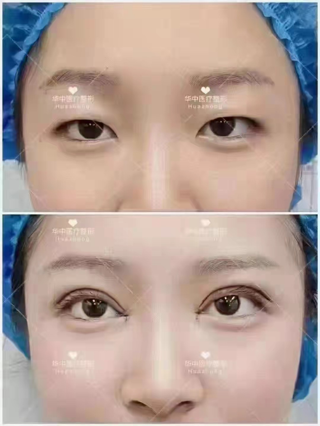 雙眼皮手術(shù)多少錢(qián)一次,埋線(xiàn)好還是割好? - 華中醫療集團，雙眼皮原價(jià)9800元現特價(jià)1680元